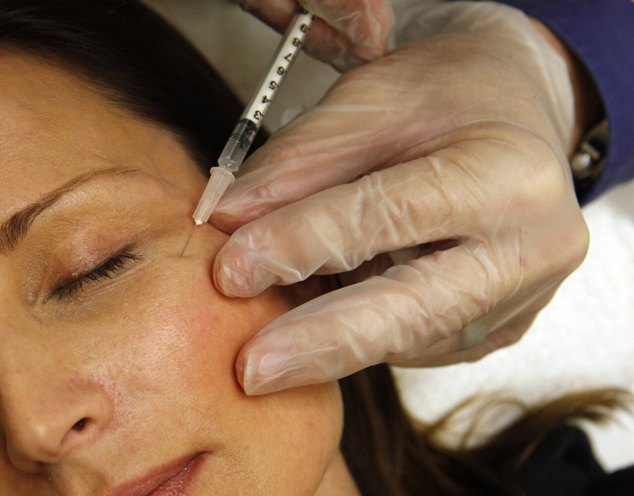 allergan-botoks