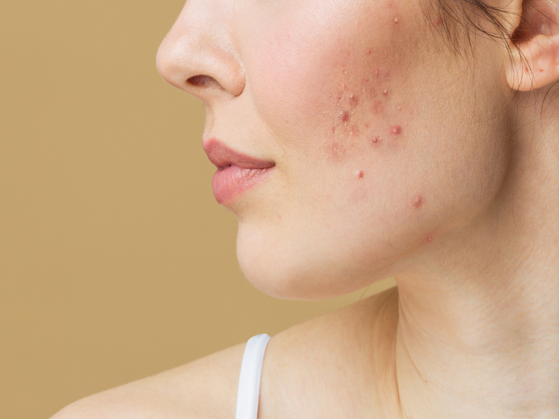 ankara mikroigneleme ile akne izi tedavisi icin uygun zaman nasil secilir